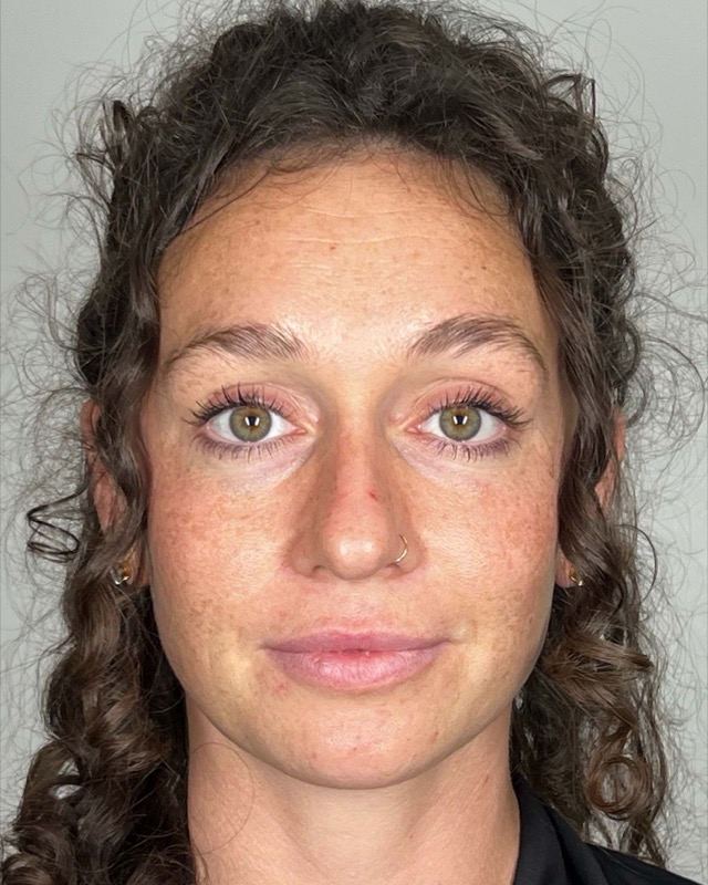 Juvederm Before & After Image
