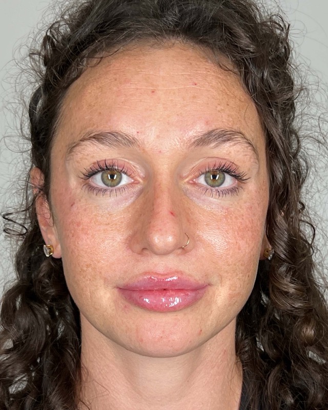 Juvederm Before & After Image