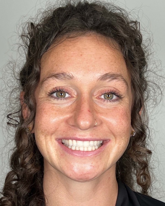 Juvederm Before & After Image