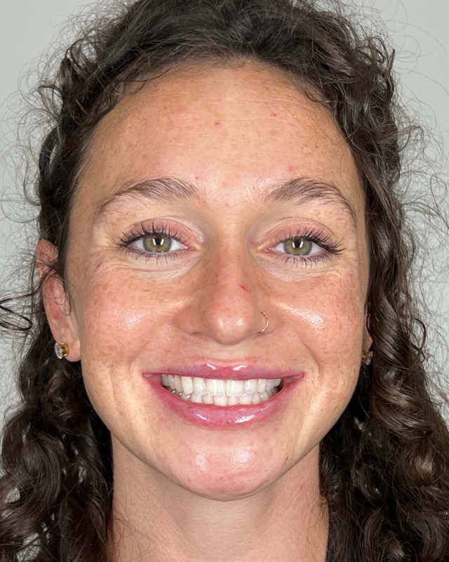 Juvederm Before & After Image