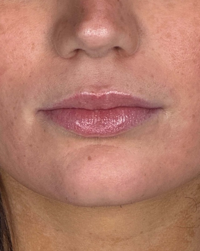Juvederm Before & After Image