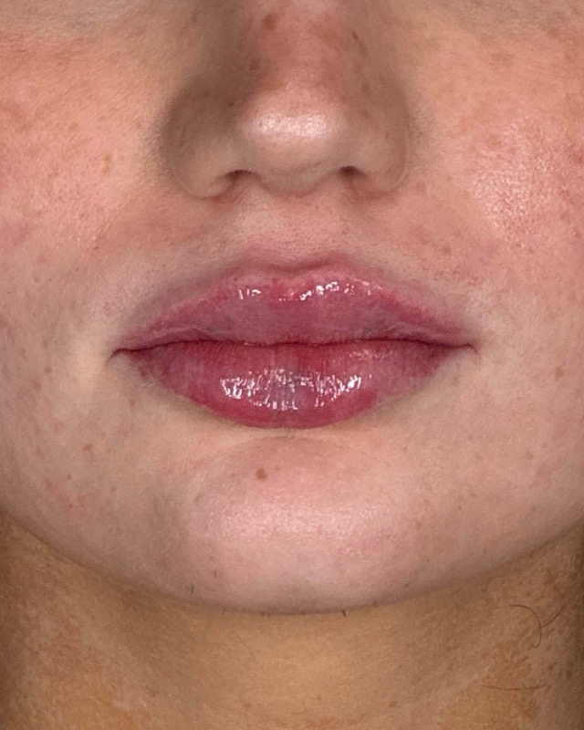 Juvederm Before & After Image