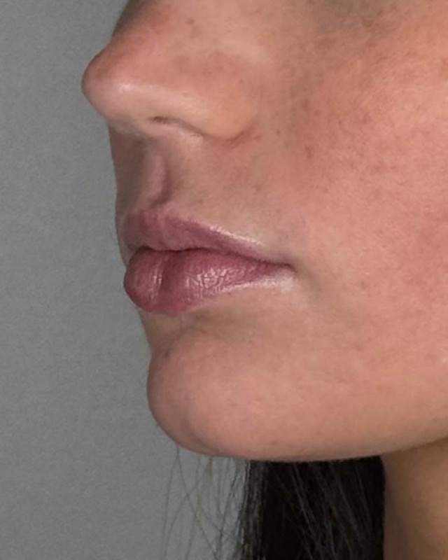 Juvederm Before & After Image