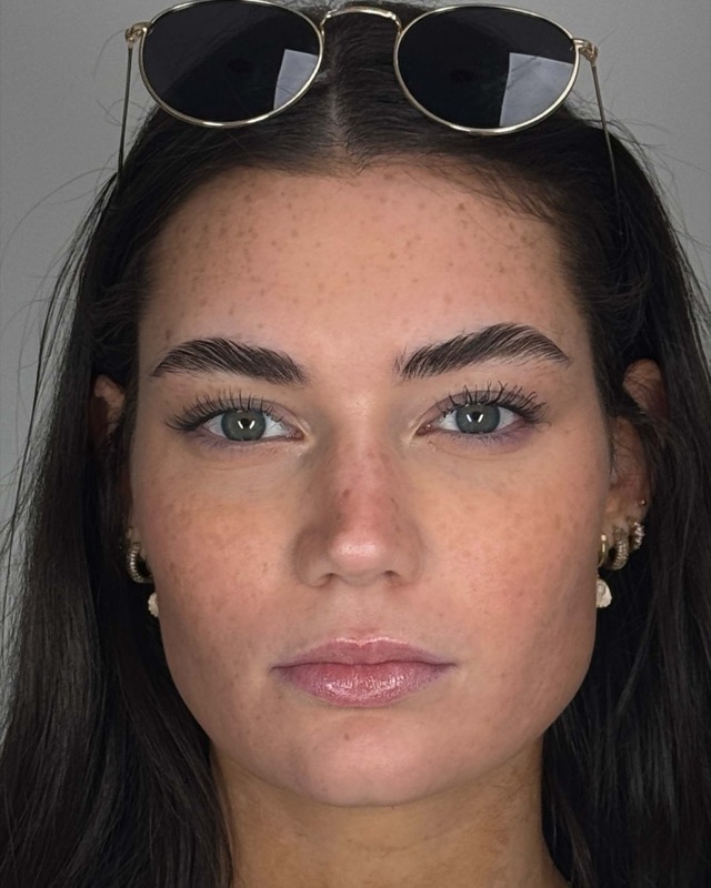 Juvederm Before & After Image