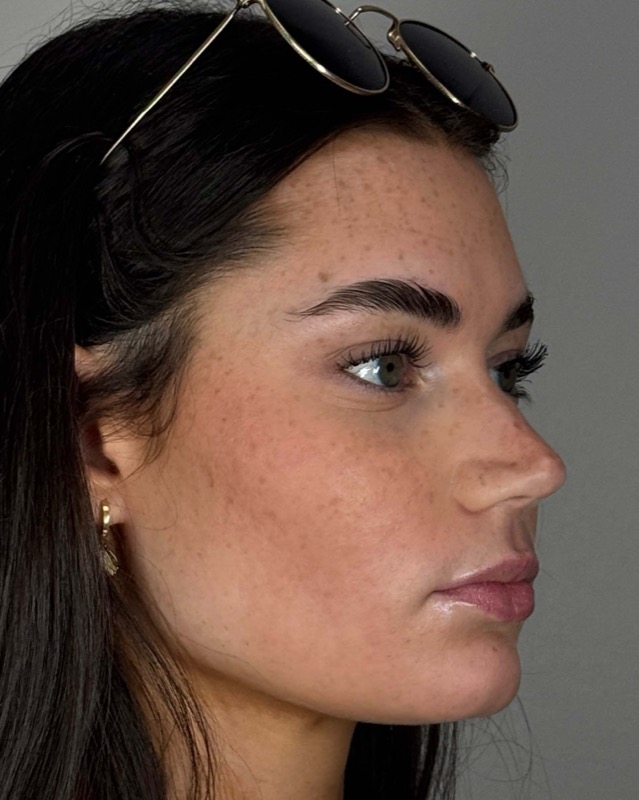 Juvederm Before & After Image