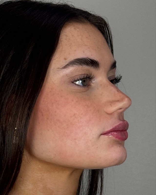 Juvederm Before & After Image