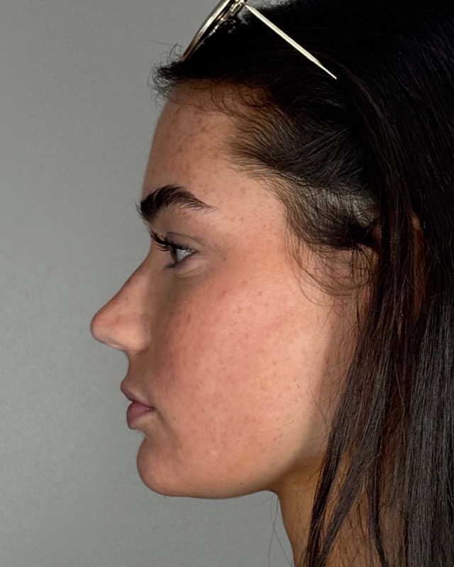 Juvederm Before & After Image