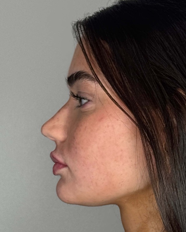 Juvederm Before & After Image