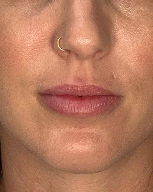 Juvederm Before & After Image