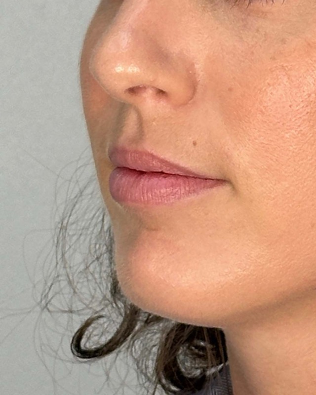 Juvederm Before & After Image