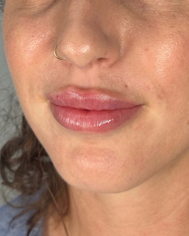 Juvederm Before & After Image