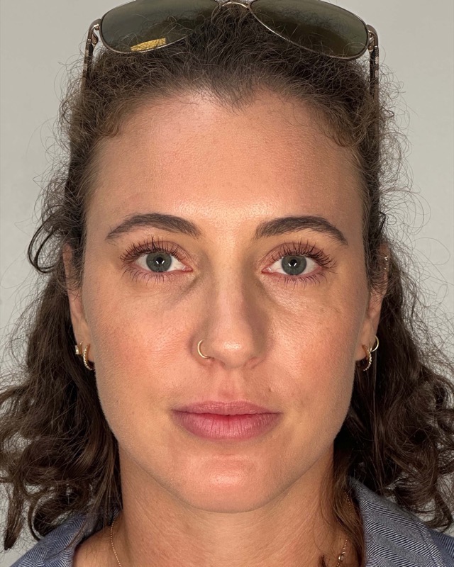 Juvederm Before & After Image