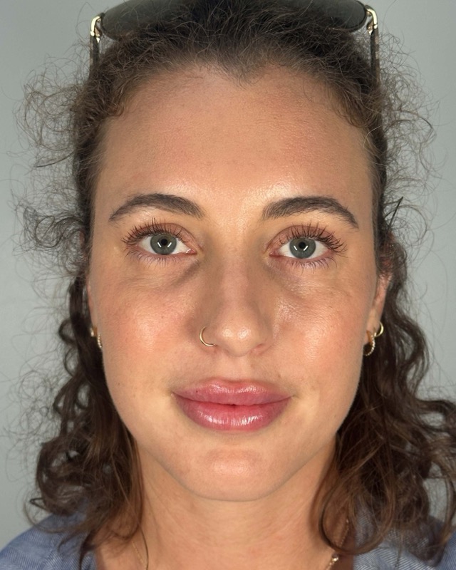 Juvederm Before & After Image