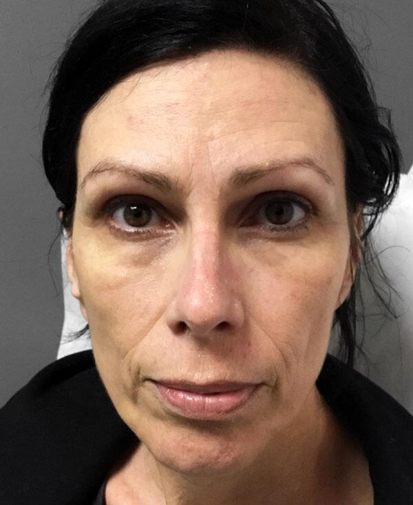 Sculptra Before & After Image